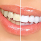 Teeth Whitening Tooth Bleaching