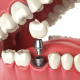 Implant Treatment: Implant Dental, Implant Teeth, What is Implant